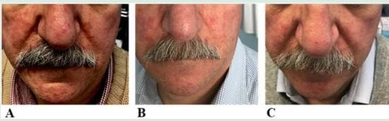 Acne Rosacea