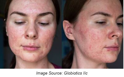 Rosacea images