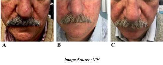 Rosacea images